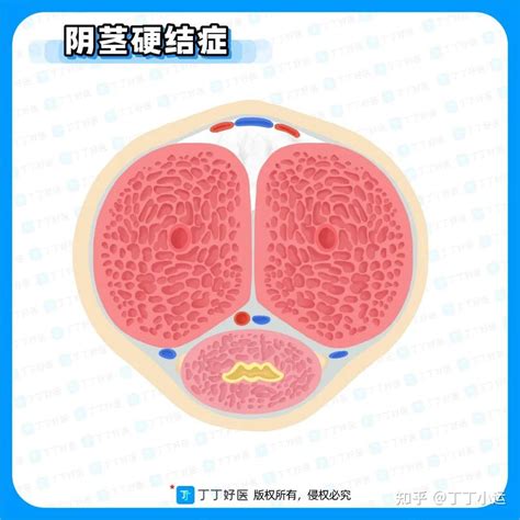 阴茎黑点